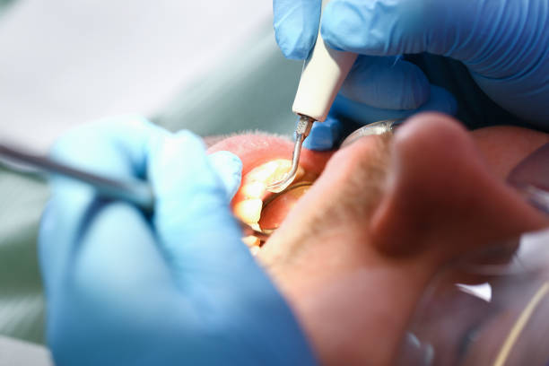 Best Emergency Treatment for Dental Infections or Abscesses in St James, MN