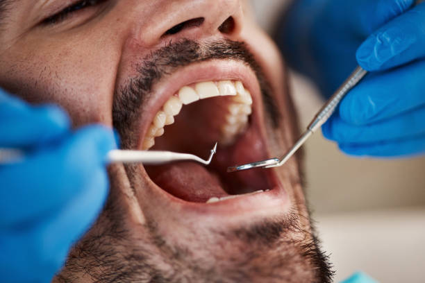 Best Emergency Dental Care for Broken or Chipped Teeth in St James, MN