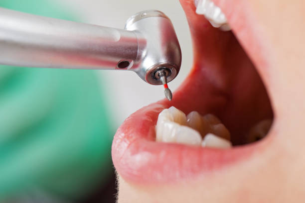 Best Emergency Wisdom Teeth Removal in St James, MN